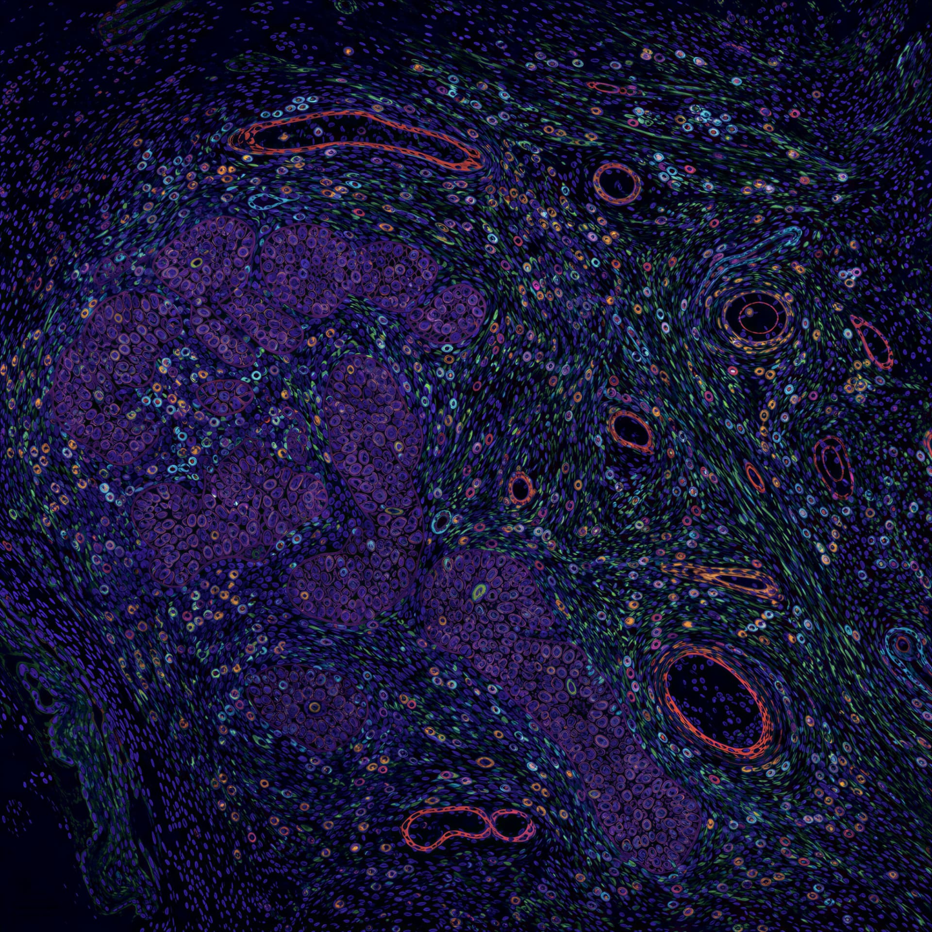 Spatial map of an ovarian tumour microenvironment